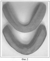 Способ протезирования на беззубой нижней челюсти с повторением рельефа внутренней поверхности базиса старого протеза у пациентов с неблагоприятными клиническими условиями протезного ложа (патент 2293541)