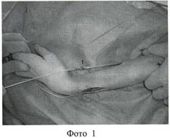 Способ устранения сгибательной установки в лучезапястном суставе, сопровождающейся ульнарной девиацией кисти у больных с детским церебральным параличом (патент 2475201)