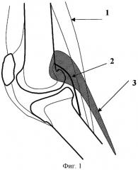 Способ коррекции тяжелой сгибательной контрактуры коленного сустава (патент 2278629)