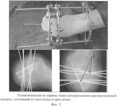 Способ создания функциональности короткой культи предплечья (патент 2392893)