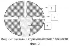 Способ переднего комбинированного спондилодеза при воспалительных заболеваниях позвоночника (патент 2364362)