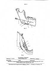 Способ лечения инфицированных переломов нижней челюсти (патент 1694131)