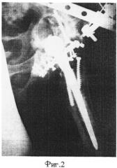 Способ стабилизации и репозиции при внеочаговом остеосинтезе переломов костей таза (патент 2482809)