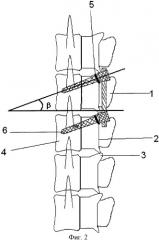 Способ моделирования транспедикулярной фиксации позвоночника в растущем организме (патент 2359339)