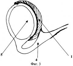Способ лоскутной перитонизации кишечника для профилактики развития послеоперационных спаек в абдоминальной хирургии (патент 2275865)