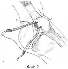 Способ реконструкции медиальной пателло-феморальной связки (патент 2520254)