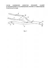 Способ замещения дефектов передней, задней большеберцовых и малоберцовой артерий аутовенозными трансплантатами (патент 2644289)