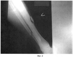 Способ лечения больных с переломами трубчатых костей (патент 2444320)