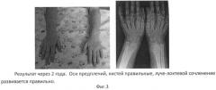 Способ оперативного лечения формирующейся косорукости у детей младшего возраста при экзостозной хондродисплазии (патент 2504340)