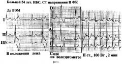 Способ диагностики ишемических желудочковых нарушений ритма у больных ишемической болезнью сердца (патент 2280402)