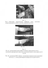 Способ свободной отсроченной пластики кожным аутотрансплантатом при травматических отслойках кожи (патент 2665676)