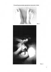 Способ разделения сросшихся пальцев стопы (патент 2661716)