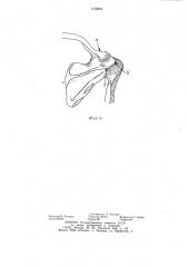 Аппарат для лечения вывиха акромиального конца ключицы (патент 1123670)