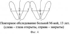 Способ прогнозирования прогрессирования сколиотической деформации (патент 2302818)