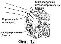 Способ лечения острого инфаркта миокарда (патент 2343921)