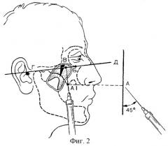 Способ обезболивания при оперативных вмешательствах в зоне иннервации верхних задних альвеолярных нервов (патент 2296590)