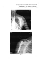 Способ оценки положения элементов плечевого сустава/эндопротеза (патент 2578858)