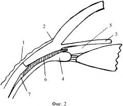Способ лечения глаукомы и имплантат для его осуществления (патент 2335272)