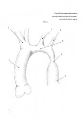 Способ пластики коарктации и рекоарктации аорты в сочетании с гипоплазией дуги аорты (патент 2621953)