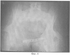 Способ лечения больных с неправильно сросшимися множественными переломами костей таза (патент 2328998)