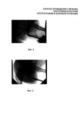 Способ проведения рентгенконтрастной уретрографии в боковой проекции (патент 2592683)
