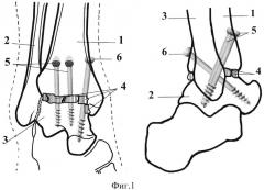 Способ выполнения артродеза голеностопного сустава с использованием трех спонгиозных винтов (патент 2633945)