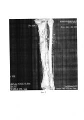 Способ стимуляции костеобразования при ишемическом регенерате на обширного размера дефекте большеберцовой кости (патент 2577765)