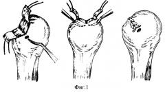 Способ пластики импрессионных дефектов головки плечевой кости (патент 2290122)