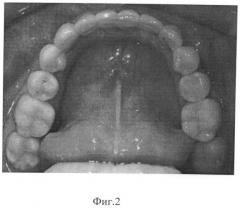 Способ ретенции результата ортодонтического лечения глубокого резцового перекрытия (патент 2495643)