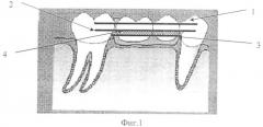 Мостовидный протез для восстановления отсутствующих второго премоляра и/или первого моляра прямым методом (патент 2333733)