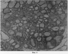 Способ восстановления функции щитовидной железы (патент 2290086)