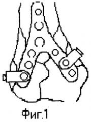 Способ фиксации костных отломков мыщелков (патент 2254081)