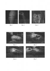 Хирургический доступ к латеральному мыщелку большеберцовой кости фасциопластический с остеотомией бугорка жерди (патент 2654593)