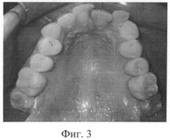 Способ ретенции результата ортодонтического лечения глубокого резцового перекрытия (патент 2495643)