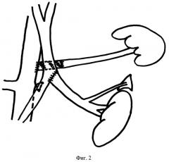Способ односторонней портализации надпочечниковой и почечной крови (патент 2422101)