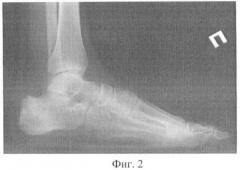 Способ лечения остеомиелита пяточной кости (патент 2407469)