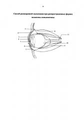 Способ расширенной энуклеации при распространенных формах меланомы конъюнктивы (патент 2638443)