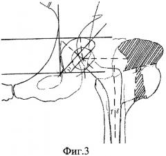 Способ моделирования большого вертела при эндопротезировании тазобедренного сустава (патент 2410053)