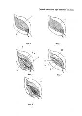 Способ операции при паховых грыжах (патент 2585734)