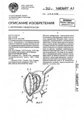 Способ пилоропластики (патент 1683697)