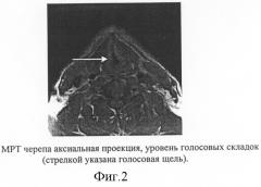 Способ определения уровня резекции мягкого неба и небного язычка у лиц голосоречевых профессий, страдающих феноменом храпа и синдромом обструктивного сонного апноэ (патент 2299676)