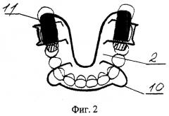 Аппарат для лечения гнатической формы мезиальной окклюзии у подростков (патент 2547789)
