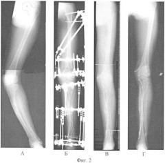 Способ лечения деформации костей конечностей у больных с метаболическими остеопатиями и несовершенным остеогенезом (патент 2342914)