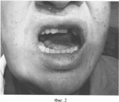 Способ оперативного лечения разлитых и гнилостно-некротических флегмон дна полости рта (патент 2328230)
