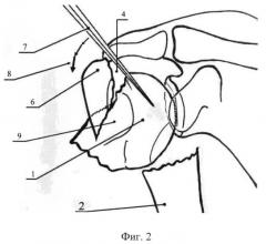 Способ репозиции отломков при закрытом интрамедуллярном остеосинтезе переломов шейки плечевой кости (патент 2513594)