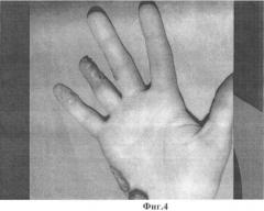 Способ кожно-костной реконструкции пальца кисти (патент 2482803)