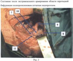 Способ экстравазального армирования сонных артерий при операции каротидной эндартерэктомии (патент 2485897)