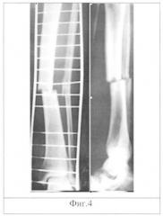 Способ трехмерной визуализации длинных трубчатых костей при диафизарных переломах (патент 2342077)