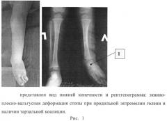 Способ устранения эквино-плоско-вальгусной деформации стопы при продольной эктромелии голени и наличии тарзальной коалиции (патент 2535618)