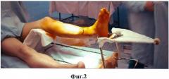 Способ лечения внутрисуставных переломов дистального отдела голени (патент 2442546)